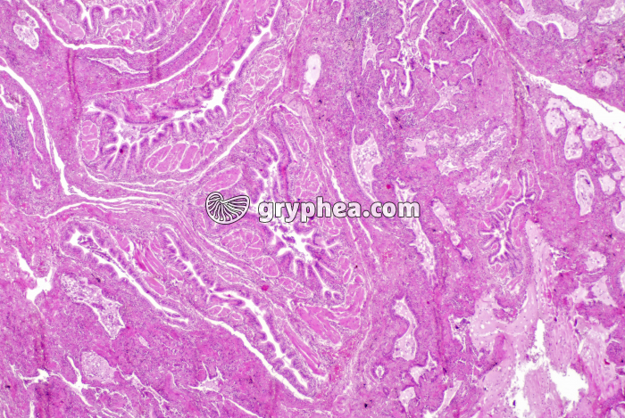 Poumon fumeur x7 - gryphea.org